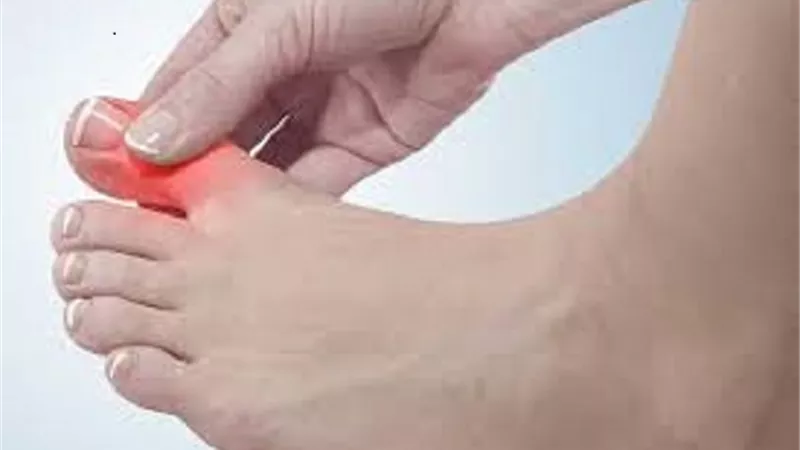 الممنوع والمسموح لمرضى النقرس