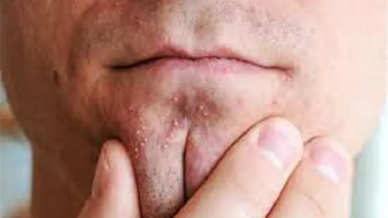 هل يظهر لديك حب الشباب فى منطقة الذقن ؟ اليك طرق العلاج