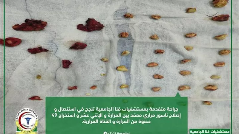 استخراج ٤٩ حصوة من القناة المرارية لمريضة بمستفيات قنا الجامعية