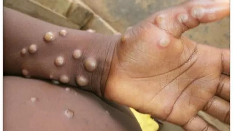السودان: تسجيل 5 إصابات جديدة بجدري القردة