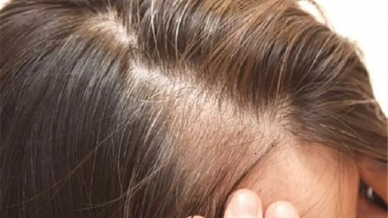 طرق طبية ومنزلية لعلاج انسداد بصيلات الشعر