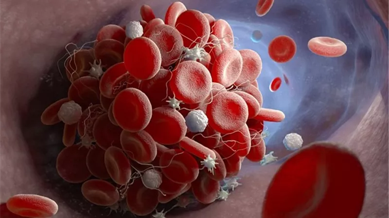 منها الثوم والكيوى .. أطعمة تذيب الجلطات الدموية