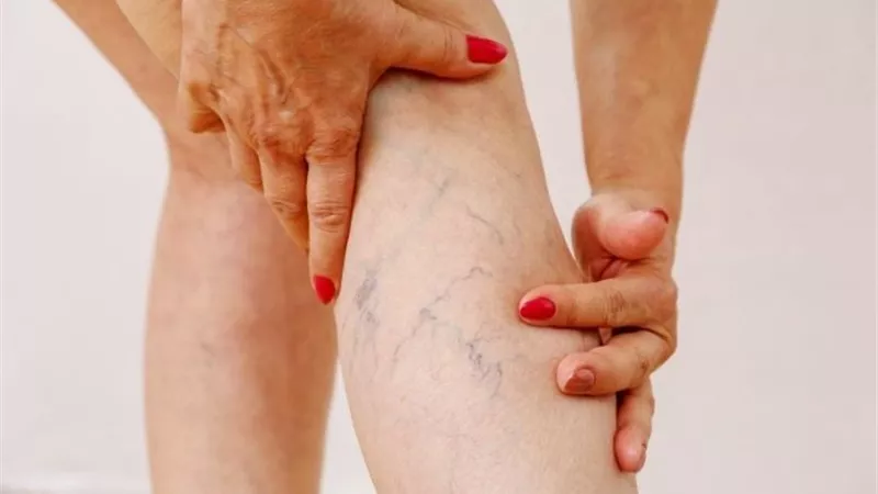 لماذا تصاب السيدات بدوالي الساقين بعد الحمل والرضاعة؟.. اعرفي السبب