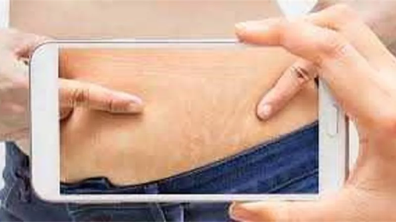 علاج تشققات البطن طبيا ومنزليا