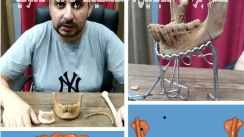 نجاح أول حالة إعادة بناء للفك بعد إستئصاله جراحيا لوجود ورم خبيث