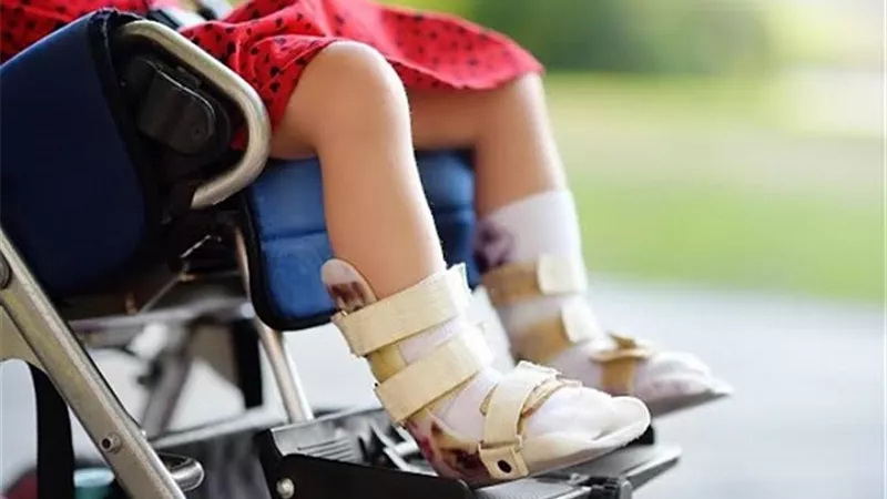 3 أعراض قد تشير للاصابة بشلل الاطفال
