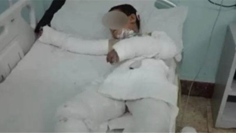 طفلان يحرقان صديقهما بمادة مشتعلة علي سبيل المزاح في أوسيم