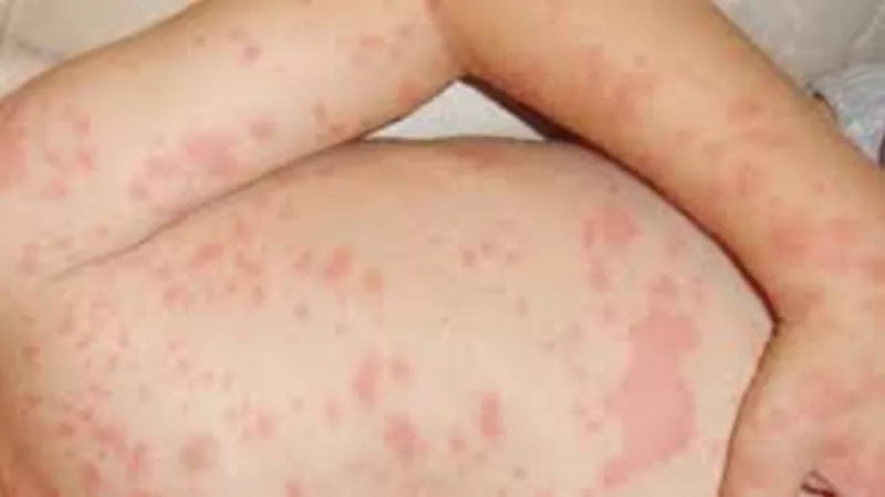 أمريكا تسجل عشرات الإصابات بالحصبة خلال أسبوع