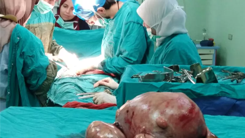 استئصال ورم 20 كيلو من رحم سيدة بـتأمين بني سويف