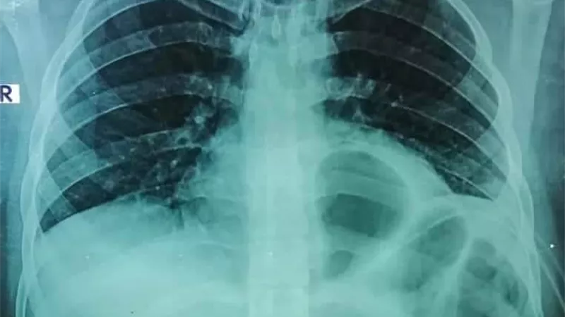 إنقاذ حياة شاب تعرض لطعنة مطواة بالصدر في مستشفي بنها الجامعي