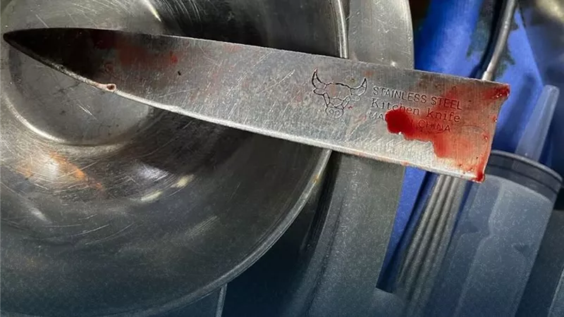 استخراج سكين مطبخ من صدر طفلة تبلغ من العمر ١٢ عاما