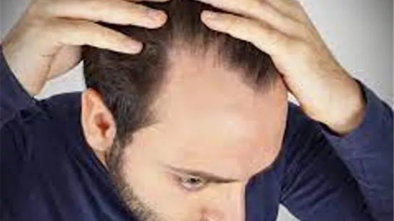 احذر..مشروبات شائعة تسبب الصلع عند الرجال