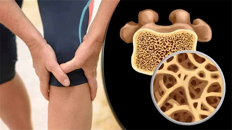 تعرف على طرق الوقاية من هشاشة العظام