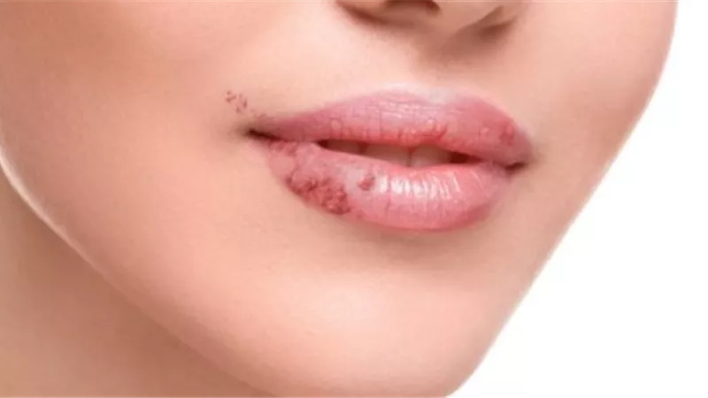 احذر..الهربس يزيد من خطر تطور مرض الزهايمر