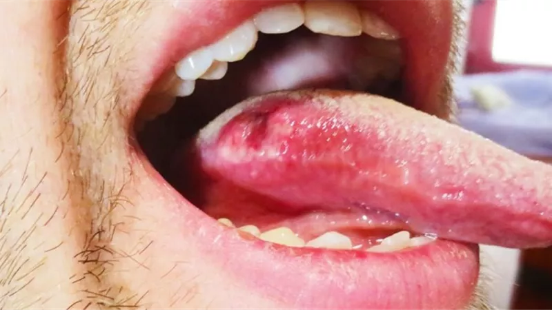أسباب وأعراض سرطان اللسان