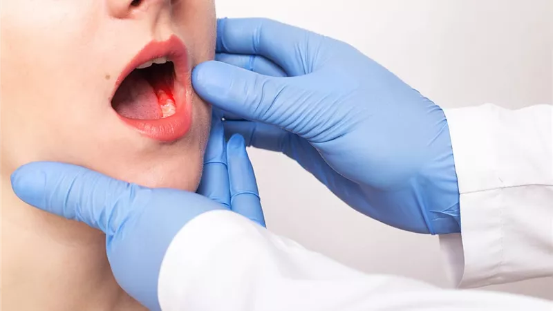 6 أعراض لسرطان الفم يجب أن يعرفها الجميع