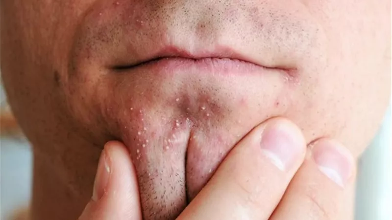 أسباب وعلاج ظهور حبوب الذقن عند الرجال