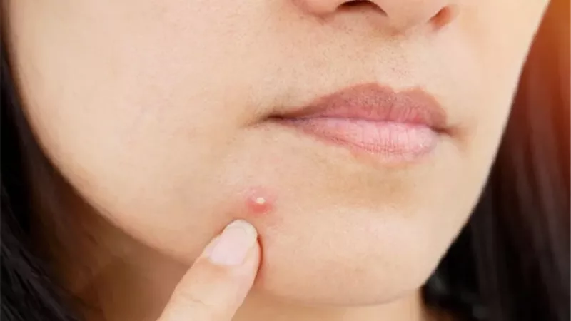 3 نصائح لعلاج البثور والحبوب