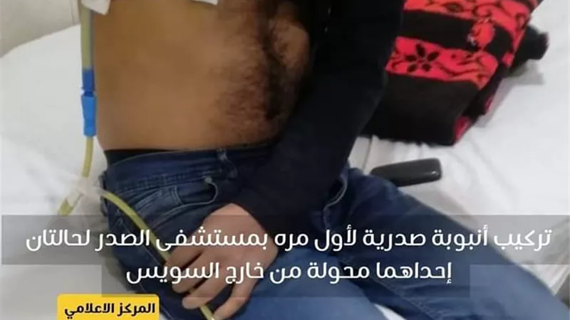تركيب أنبوبة صدرية لأول مره بمستشفى الصدر بالسويس