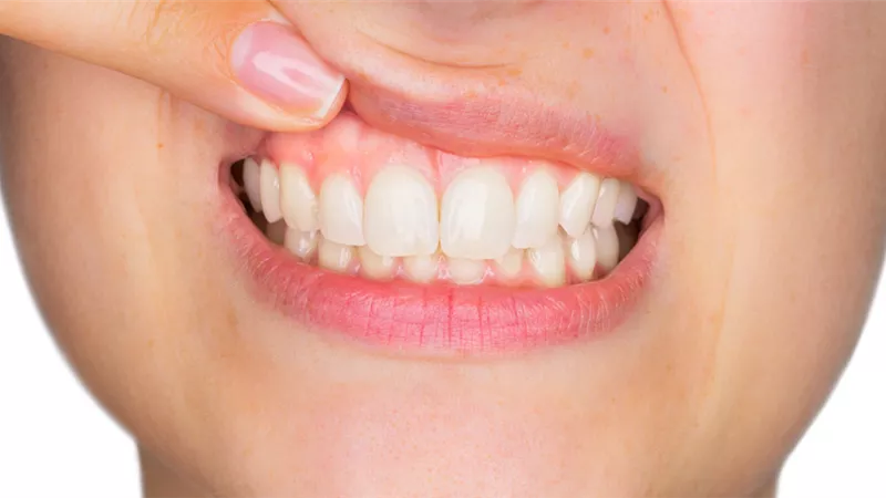 3 طرق طبيعية لعلاج التهاب اللثة