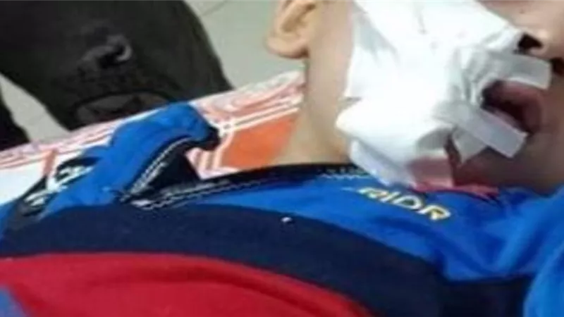 كلب ضال يصيب طفل بجروح خطيرة فى المنوفية