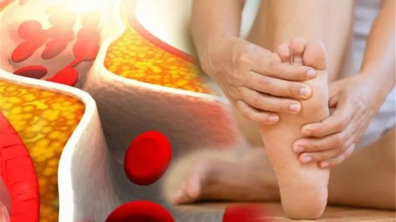علامات اذا ظهرت عليك فإنك تعانى من ارتفاع نسبة الكوليسترول..احذر