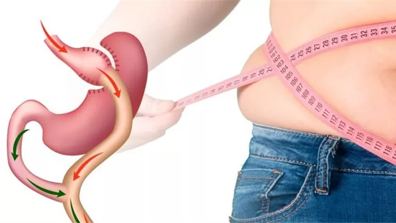 أضرار عملية تكميم المعدة.. تعرف عليها