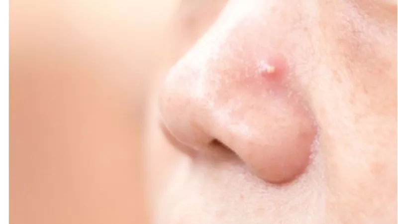 خطوات للتخلص من الحبوب البيضاء