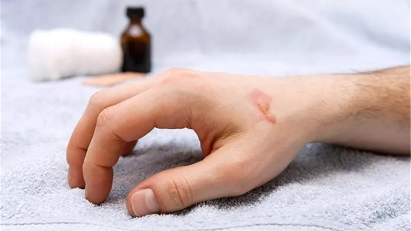 ابتكار طريقة لعلاج الجروح سريعاً باستخدام الأقطاب الكهربائية