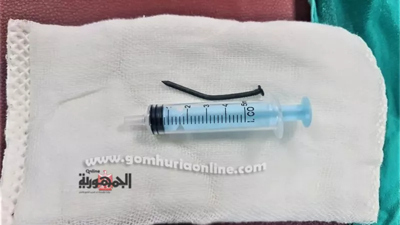 استخراج مسمار طوله 6 سم بالمنظار من بطن طفل في المنصورة