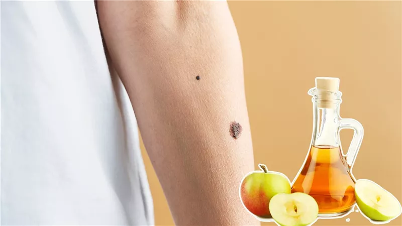 خل التفاح علاج فعال للتخلص من الشامات