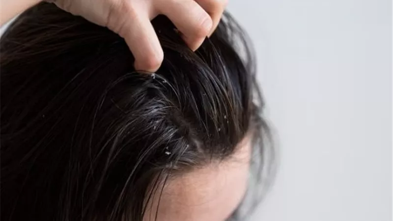 5 طرق لحماية الشعر من القمل