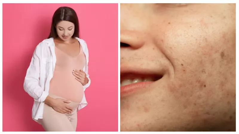 5طرق لعلاج كلف الحمل