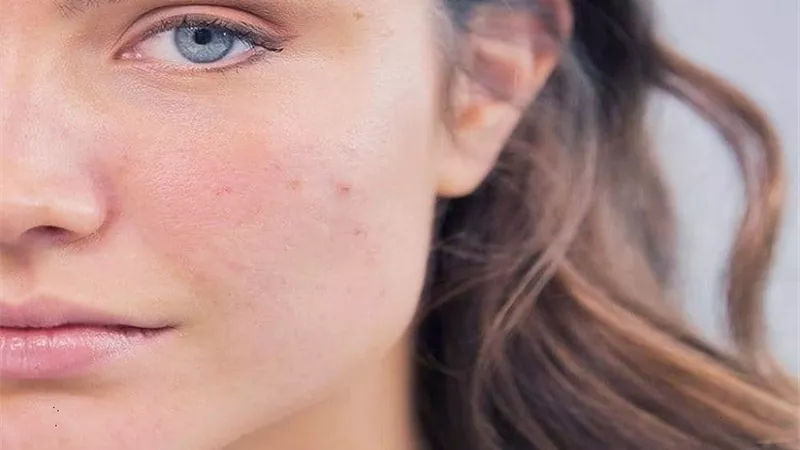 5 اسباب للمسام الواسعة ..تعرف عليها
