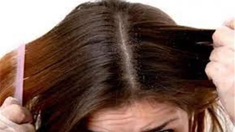 جل الصبار لتخلص من قشرة الشعر