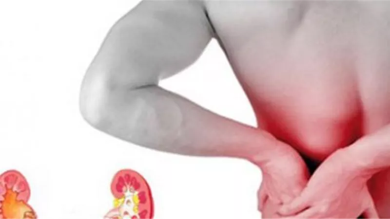 تعرف على أعراض الحصوات على الكلى.. 