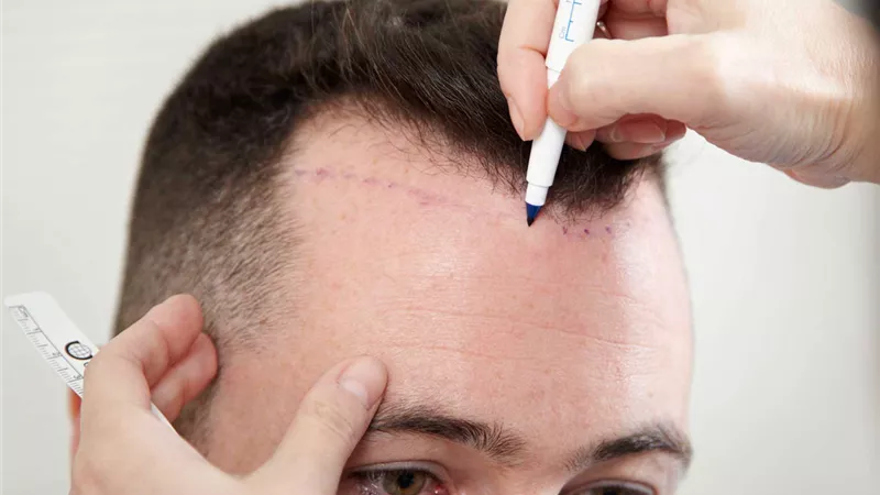 معلومات مهمة عن عملية زراعة الشعر بتقنية السفير