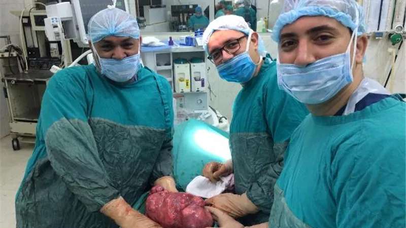 استئصال ورم يزن ٤٠ كليو جرام من سيدة بمركز اورام طنطا