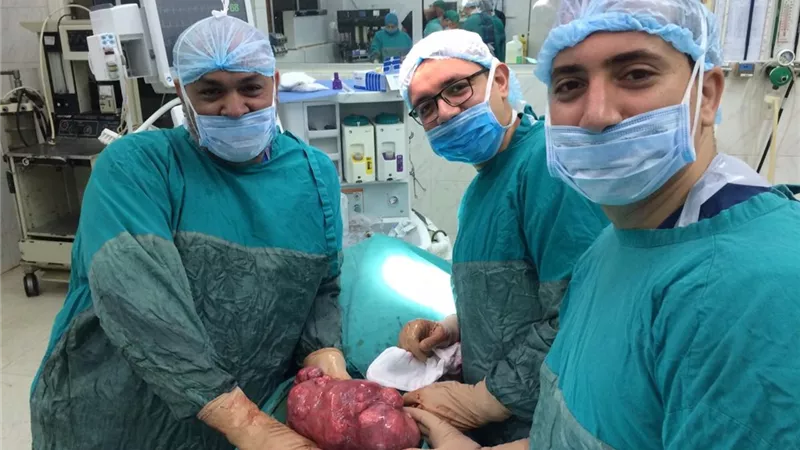استئصال ورم يزن 40 كيلو لسيدة بمركز اورام طنطا