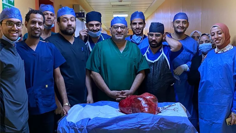 فريق طبي بجامعة أسيوط ينجح في استئصال ورم ضخم يزن (30)كيلو