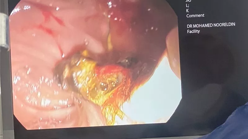 إجراء منظار معدة للمرة الأولى بعد تشغيل وحدة مناظير أطفال بلبيس