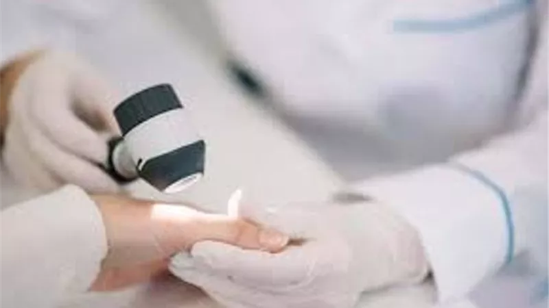 اكتشاف علاج جديد لاضطراب جلدي وراثي نادر
