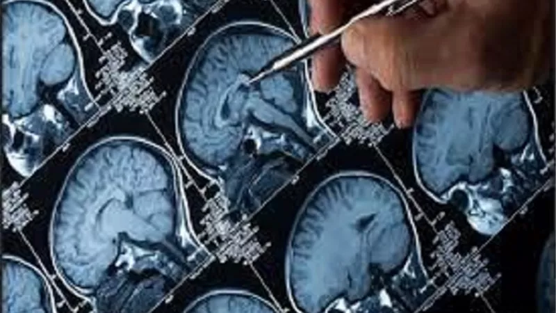 للوقاية من أورام الدماغ.. التخلي عن العادات السيئة