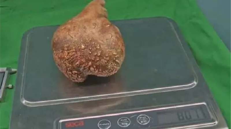 أطباء ينجحون فى استئصال أكبر وأثقل حصوة بالكلى فى العالم