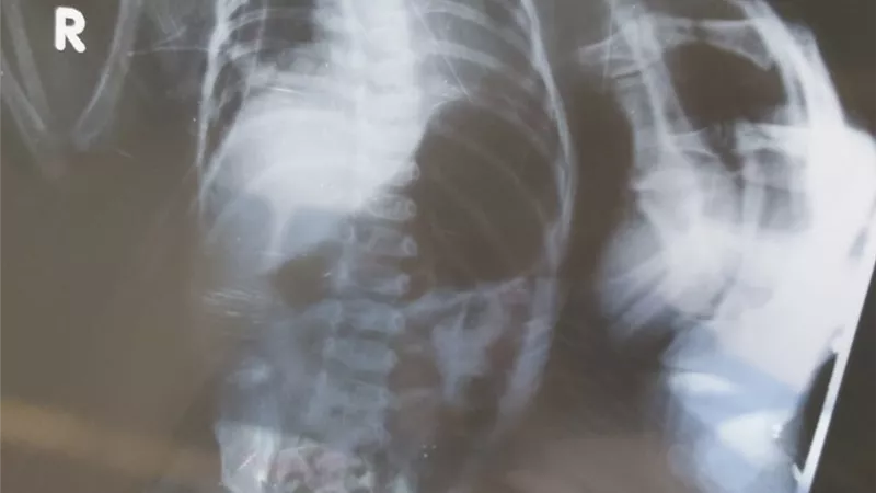 جراحة متقدمة لطفل عمره شهرين لإصلاح فتق بالحجاب الحاجز