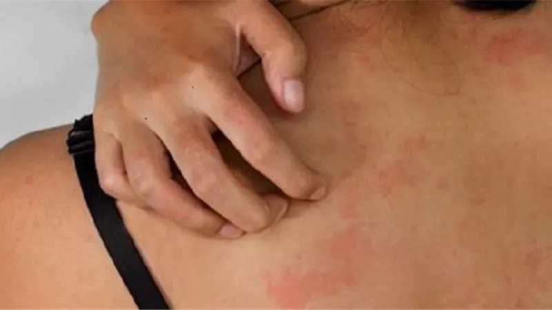 7 نصائح لتخفيف أعراض الطفح الجلدي الحراري لدى البالغين