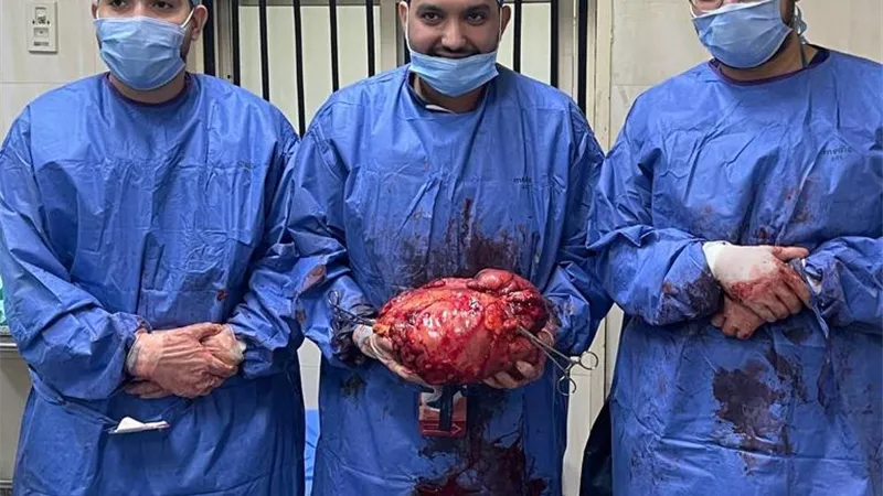 فريق طبي بمستشفيات جامعة أسيوط؛ ينجح في استئصال ورم