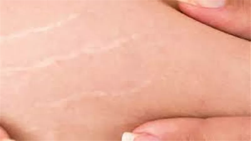 4 طرق طبيعية للتخلص من علامات التمدد بعد الولادة