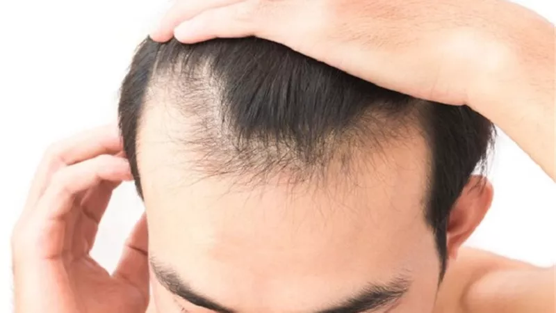 أسباب الصلع المبكر عند الرجال