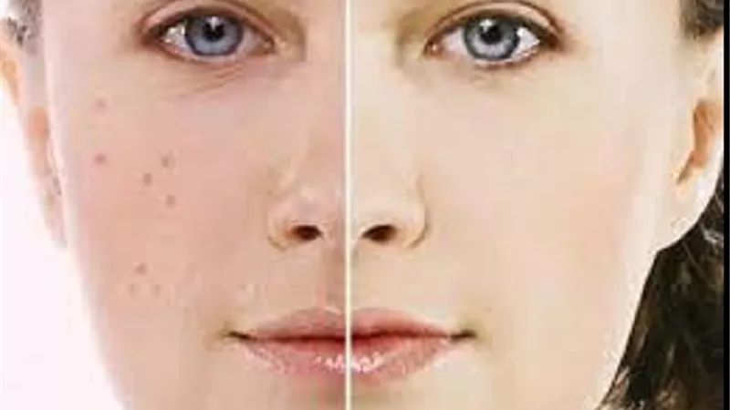 عمليات تقشير الوجه يُجيزها الشرع بشرط